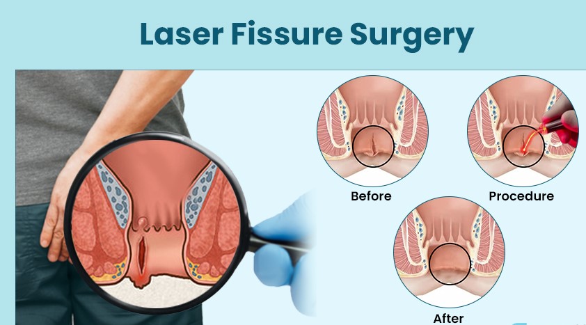 Anal Fissure Treatment and Surgery